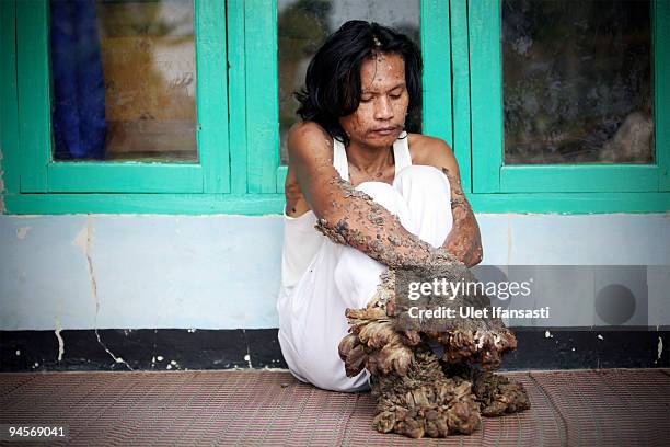 Indonesian man Dede Koswara sits in his home village on December 15, 2009 in Bandung, Java, Indonesia. Due to a rare genetic problem with Dede's...