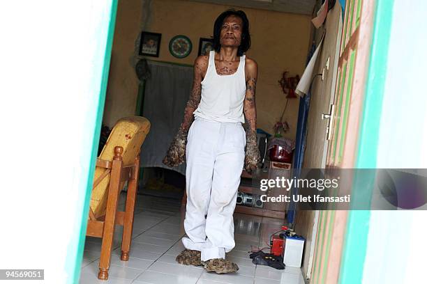 Indonesian man Dede Koswara stands in his home village on December 15, 2009 in Bandung, Java, Indonesia. Due to a rare genetic problem with Dede's...