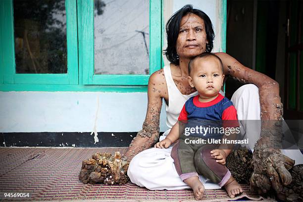 Indonesian man Dede Koswara sits with his cousin Andra in his home village on December 15, 2009 in Bandung, Java, Indonesia. Due to a rare genetic...