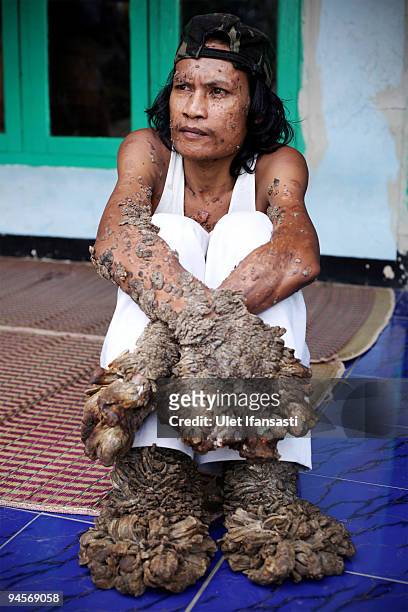 Indonesian man Dede Koswara sits in his home village on December 15, 2009 in Bandung, Java, Indonesia. Due to a rare genetic problem with Dede's...