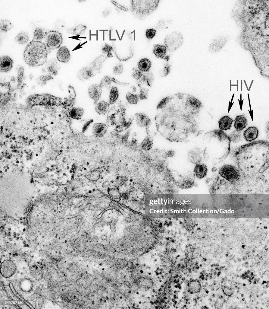 HTLV-1 And HIV