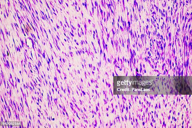 fibroma tumor cells medical micrograph of ill human - human skin cross section stock pictures, royalty-free photos & images