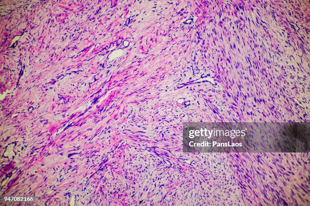 fibroma tumor cells medical micrograph of ill human - histerectomia fotografías e imágenes de stock