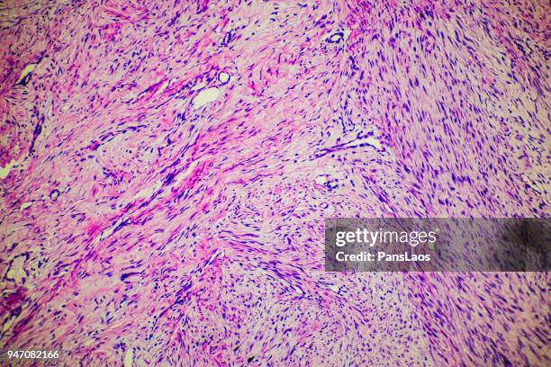 fibroma tumor cells medical micrograph of ill human - microphotographie immunofluorescente photos et images de collection