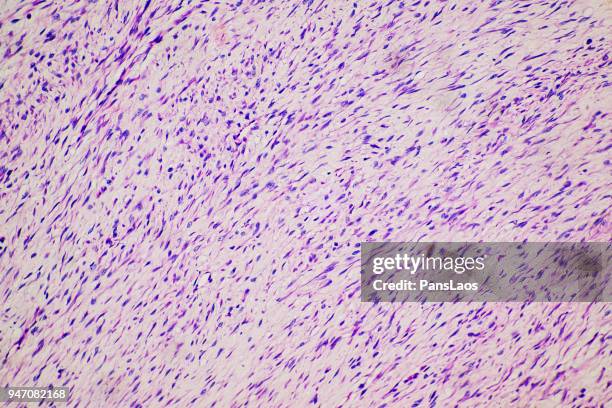 fibroma tumor cells medical micrograph of ill human - fibroma stock pictures, royalty-free photos & images