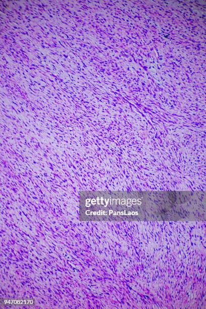 fibroma tumor cells medical micrograph of ill human - histerectomia fotografías e imágenes de stock