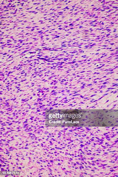 fibroma tumor cells medical micrograph of ill human - histerectomia fotografías e imágenes de stock