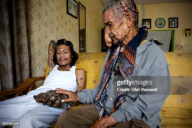 Indonesian man Dede Koswara talks with his friend Sakim in his home village on December 18, 2009 in Bandung, Java, Indonesia. Due to a rare genetic...