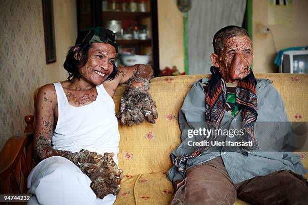 Indonesian man Dede Koswara talks with his friend Sakim in his home village on December 18, 2009 in Bandung, Java, Indonesia. Due to a rare genetic...