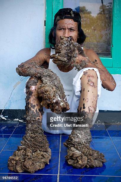 Indonesian man Dede Koswara sits outside his home on December 18, 2009 in Bandung, Java, Indonesia. Due to a rare genetic problem with Dede�s immune...