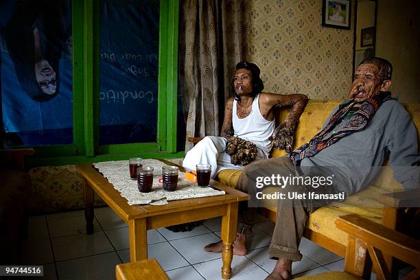 Indonesian man Dede Koswara sits with his friend Sakim in his home village on December 18, 2009 in Bandung, Java, Indonesia. Due to a rare genetic...