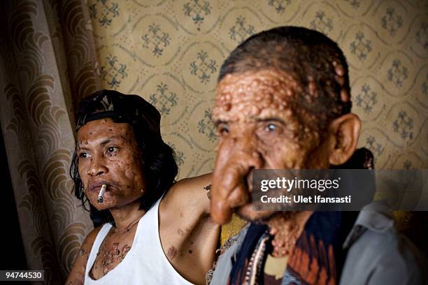 Indonesian man Dede Koswara sits with his friend Sakim in his home village on December 18, 2009 in Bandung, Java, Indonesia. Due to a rare genetic...