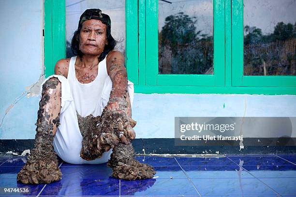 Indonesian man Dede Koswara sits outside his home on December 18, 2009 in Bandung, Java, Indonesia. Due to a rare genetic problem with Dede�s immune...