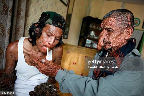 Indonesian man Dede Koswara has his cigarette lit by friend Sakim in his home village on December 18, 2009 in Bandung, Java, Indonesia. Due to a rare...
