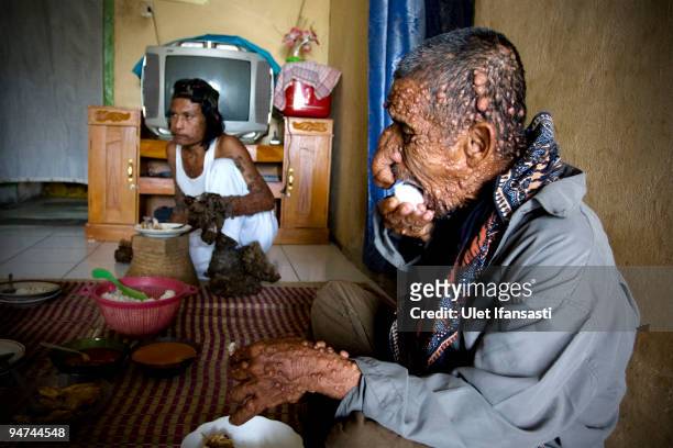 Indonesian man Dede Koswara eats with his friend Sakim in his home on December 18, 2009 in Bandung, Java, Indonesia. Due to a rare genetic problem...