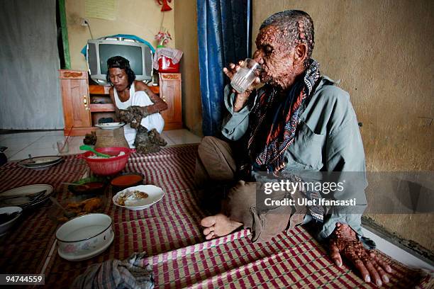 Indonesian man Dede Koswara eats with his friend Sakim in his home village on December 18, 2009 in Bandung, Java, Indonesia. Due to a rare genetic...