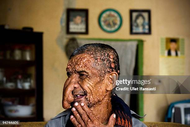 Sakim, a friend of Indonesian "Tree Man" Dede Koswara, smiles on December 18, 2009 in Bandung, Java, Indonesia. Due to a rare genetic problem with...