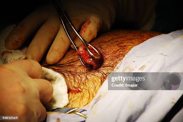 gall bladder is  coming out - laparoscopy stockfoto's en -beelden