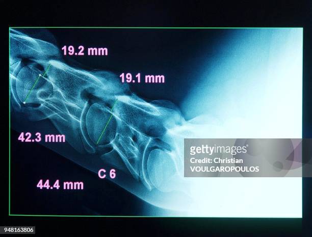 Digital x-ray of vertebras. Abnormal spacings are marked.