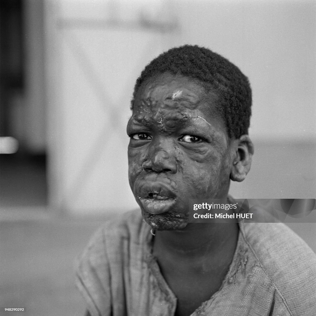 Enfant atteint de la lèpre à Bamako