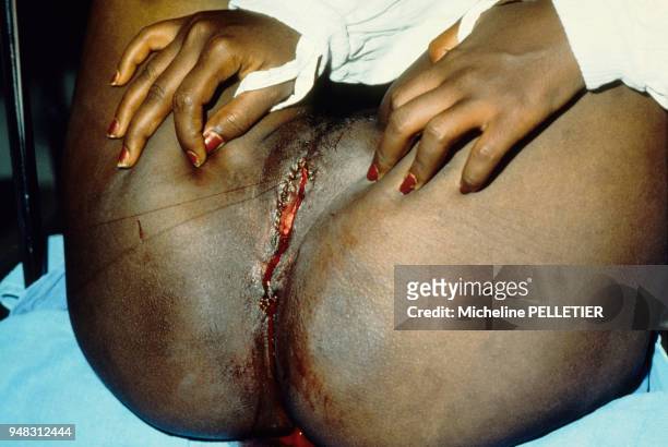 Ablation du clitoris d'une jeune femme africaine en novembre 1980 à Djibouti.