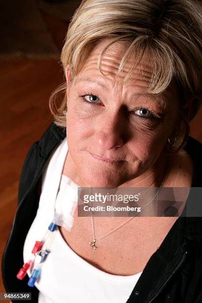 Dawn Turk, poses for a photograph with a catheter for dialysis treatments attached to her chest at her sister Barbara Patton's home in Toledo, Ohio,...