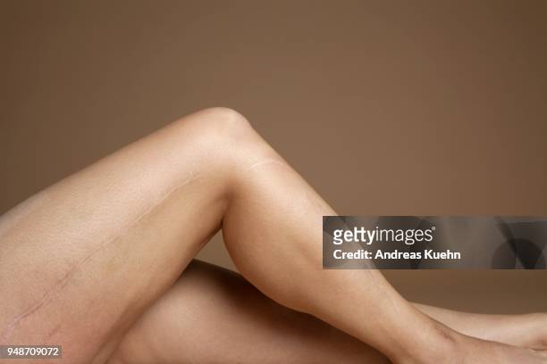 close up shot of a woman's leg with huge scars along the side. - kuit menselijk been stockfoto's en -beelden