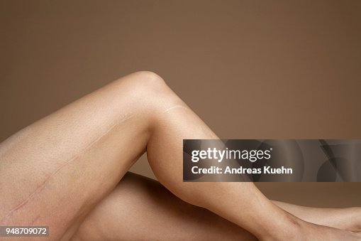 453 Leg Scars Stock Photos, High-Res Pictures, and Images - Getty