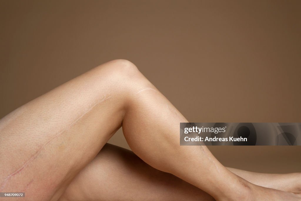 Close up shot of a woman's leg with huge scars along the side.