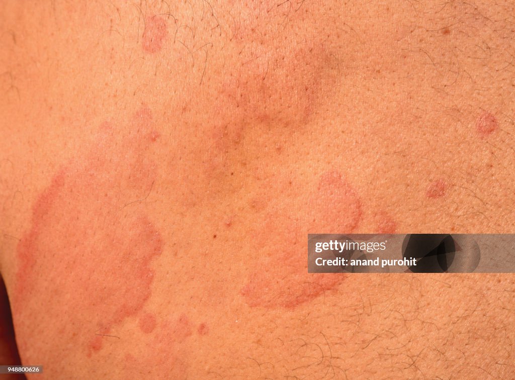 Hives - Urticaria, Skin Disease