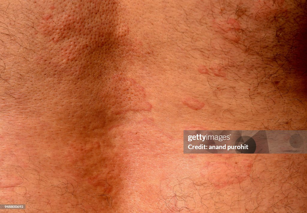 Hives - Urticaria, Skin Disease
