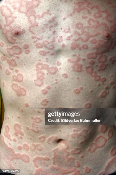 La Rash Skin Rash Photos Photos and Premium High Res Pictures - Getty Images