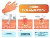 Injury inflammation biological human body response vector illustration scheme. Skin surface injury cross section poster with capillary, phagocytes and platelets.