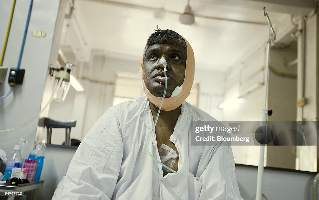 A Mouth Cancer Patient Who Chewed Tobacco Underwent An Operation In a-mouth-cancer-patient-who-chewed-tobacco-underwent-an-operation-in