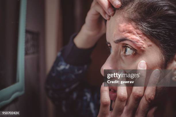 entzündungen auf stirn durch einfädeln der haut. - eyebrow threading stock-fotos und bilder