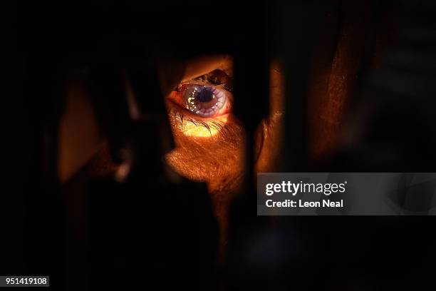 Corneal edema aphakia patient Jose, aged 87, undergoes post-operative tests after the previous days surgery at the IRO on April 19, 2018 in Trujillo,...