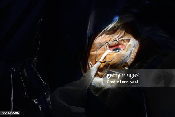 Beam of light illuminates the left eye of cataract patient Obdulia, aged 60, during surgery at the IRO on April 20, 2018 in Trujillo, Peru. Having...