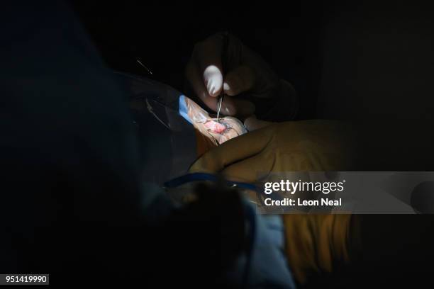 Surgeon works on the eye of Reis-Buckler syndrome patient Diana, aged 17, during surgery onboard the Orbis Flying Eye Hospital on April 20, 2018 in...