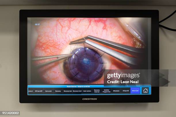 Screen shows a live feed of an eye operation taking place on Reis-Buckler syndrome patient Diana, aged 17, onboard the Orbis Flying Eye Hospital on...