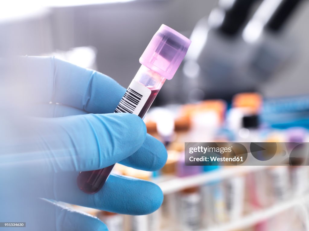 Medical technician preparing a human blood sample for clinical testing
