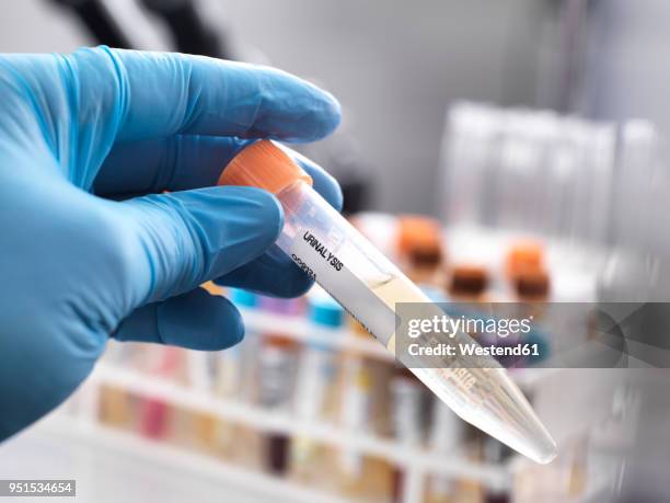 medical technician preparing a human urine sample for clinical testing - urine sample stock-fotos und bilder