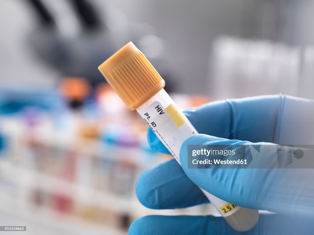 Medical technician preparing a human sample for HIV testing