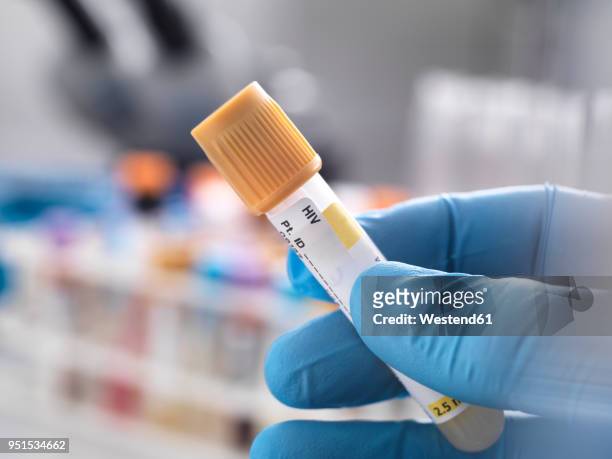 medical technician preparing a human sample for hiv testing - aids stockfoto's en -beelden