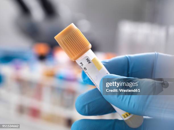 medical technician preparing a human sample for hiv testing - hiv stock pictures, royalty-free photos & images