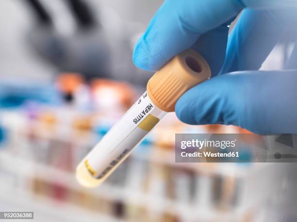 medical technician preparing a human sample for hepatitis testing - hepatite imagens e fotografias de stock