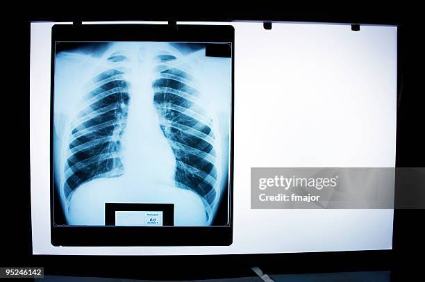 negatoscope - clavicle stock pictures, royalty-free photos & images