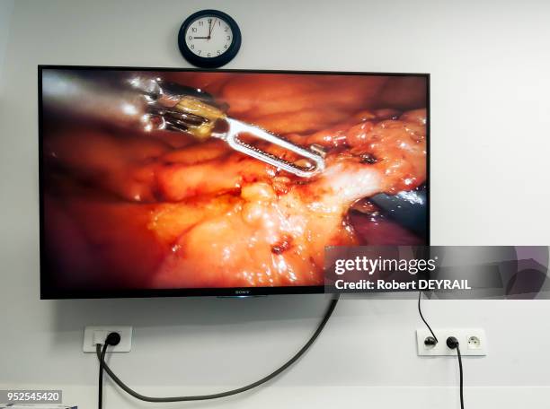 Olivier Raspado, chirurgien digestif spécialisé en chirurgie mini-invasive, coelioscopique et robotique utilise le robot 'Da Vinci S-HD' qui fournit...