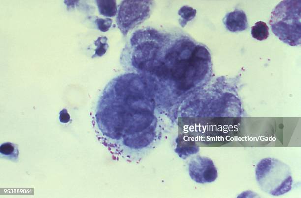 Presence of herpes simplex virus in a Tzanck test specimen revealed in the micrograph film, 1975. Image courtesy Centers for Disease Control / Joe...