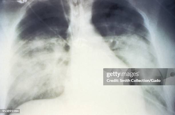 Mid-staged bilateral pulmonary effusion due to Hantavirus pulmonary syndrome , revealed in the AP chest x-ray, 1994. Image courtesy Centers for...