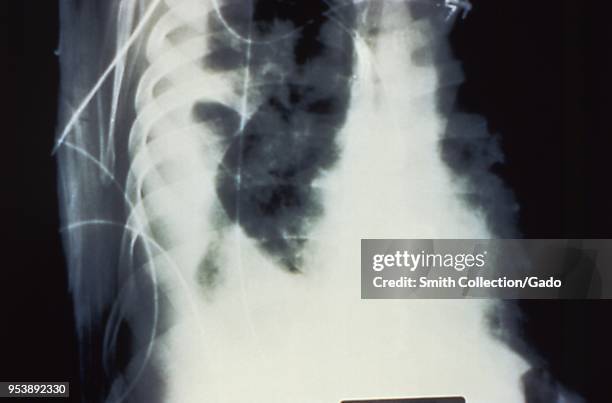 Large pulmonary effusion due to hantavirus pulmonary syndrome , revealed in the lateral decubitus chest x-ray, 1994. Image courtesy Centers for...